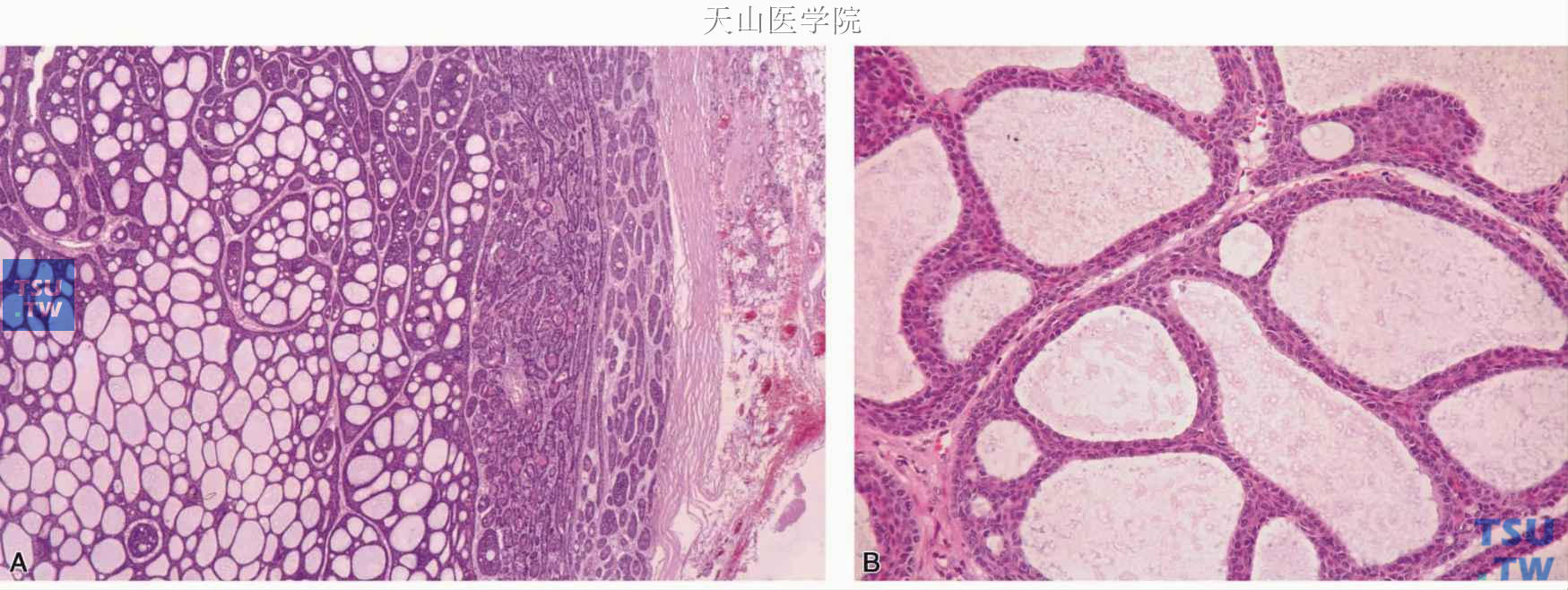 腺样囊性型基底细胞腺瘤  A.肿瘤细胞以筛孔样结构为主，包膜完整；B.筛孔样结构的高倍观