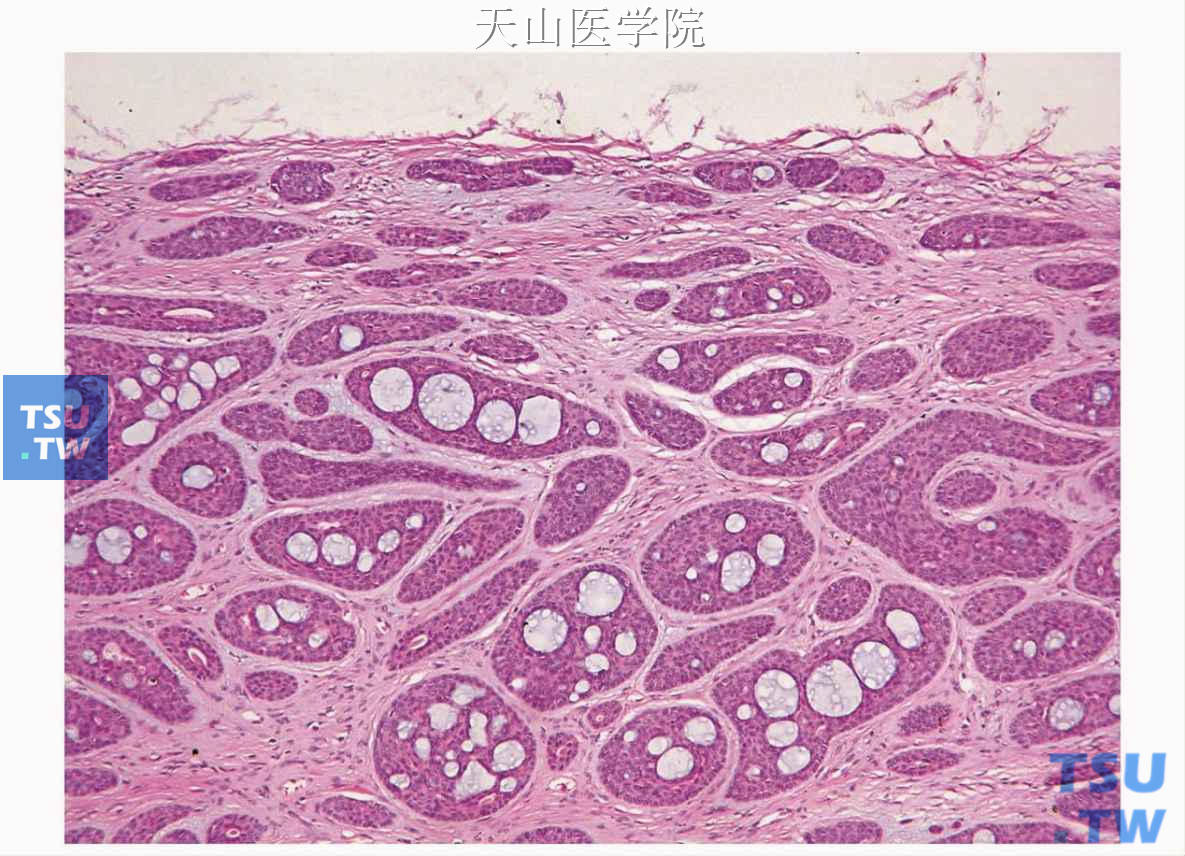 基底细胞腺瘤：肿瘤的包膜薄，肿瘤细胞仅靠包膜