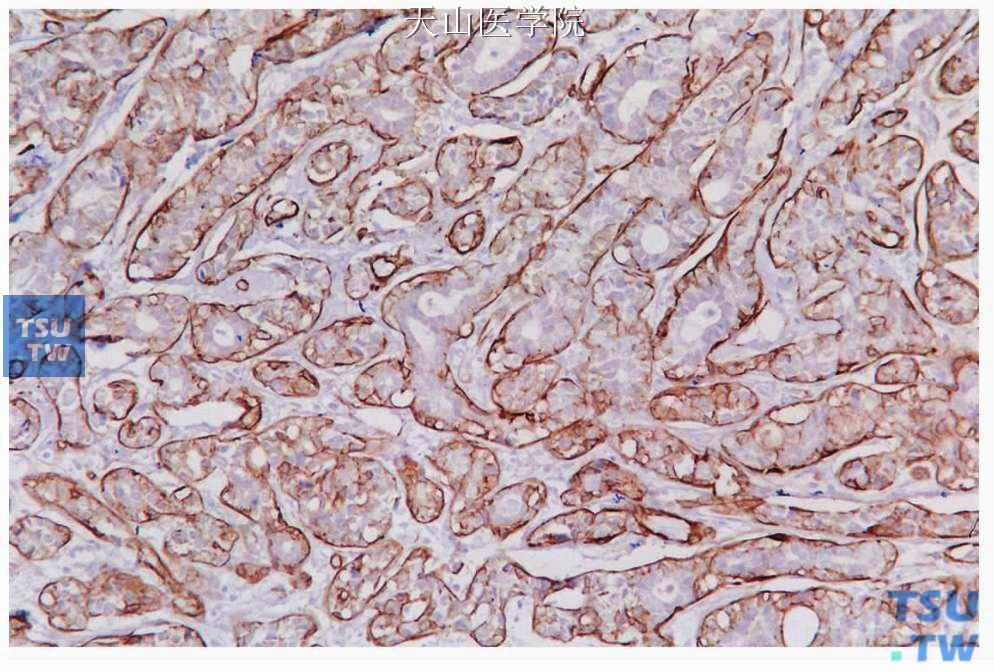 基底细胞腺瘤：肿瘤细胞条索的外围细胞表达SMA，免疫组化染色