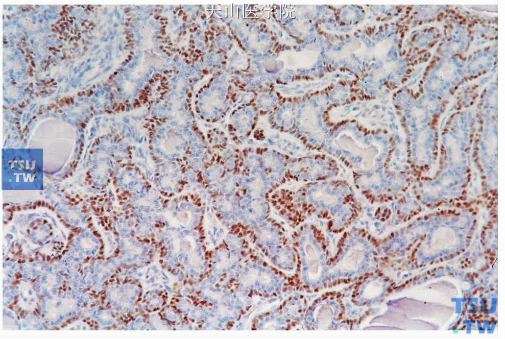 基底细胞腺瘤：肿瘤细胞条索的外围细胞表达p63，免疫组化染色