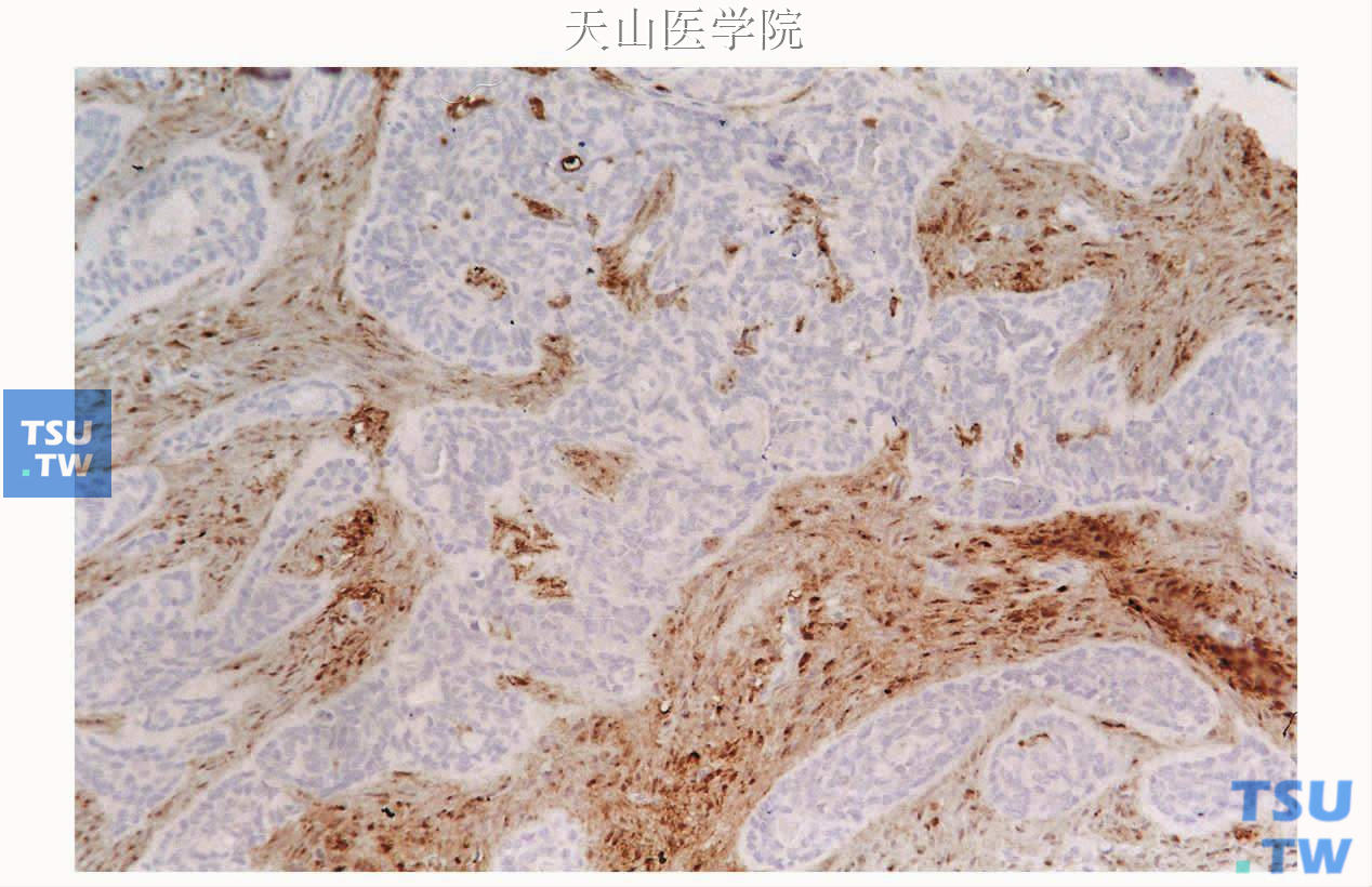 基底细胞腺瘤：肿瘤间质表达S100蛋白，免疫组化染色