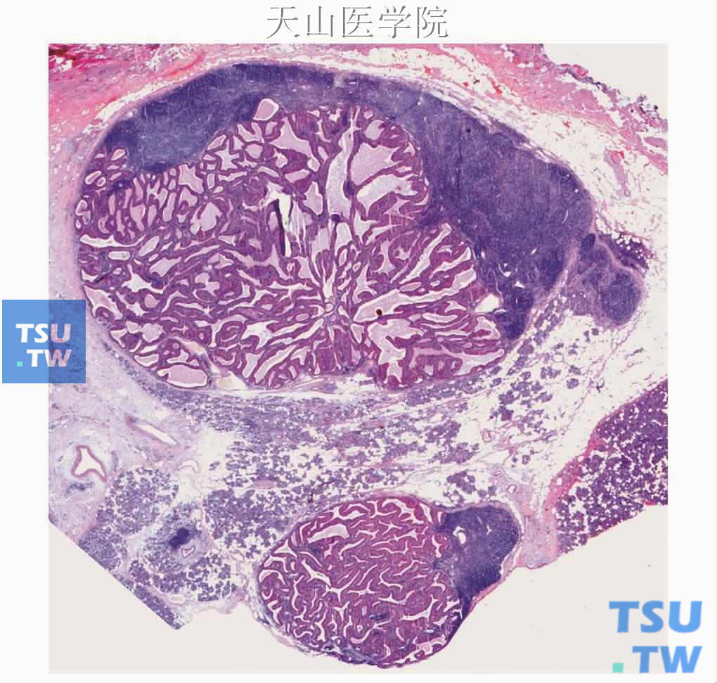 沃辛瘤:肿瘤分别发生在2个腮腺淋巴结内，尚未累及整个淋巴结