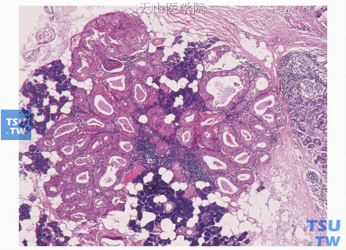 肺转移性多形性腺瘤一例 - 91360智慧病理网