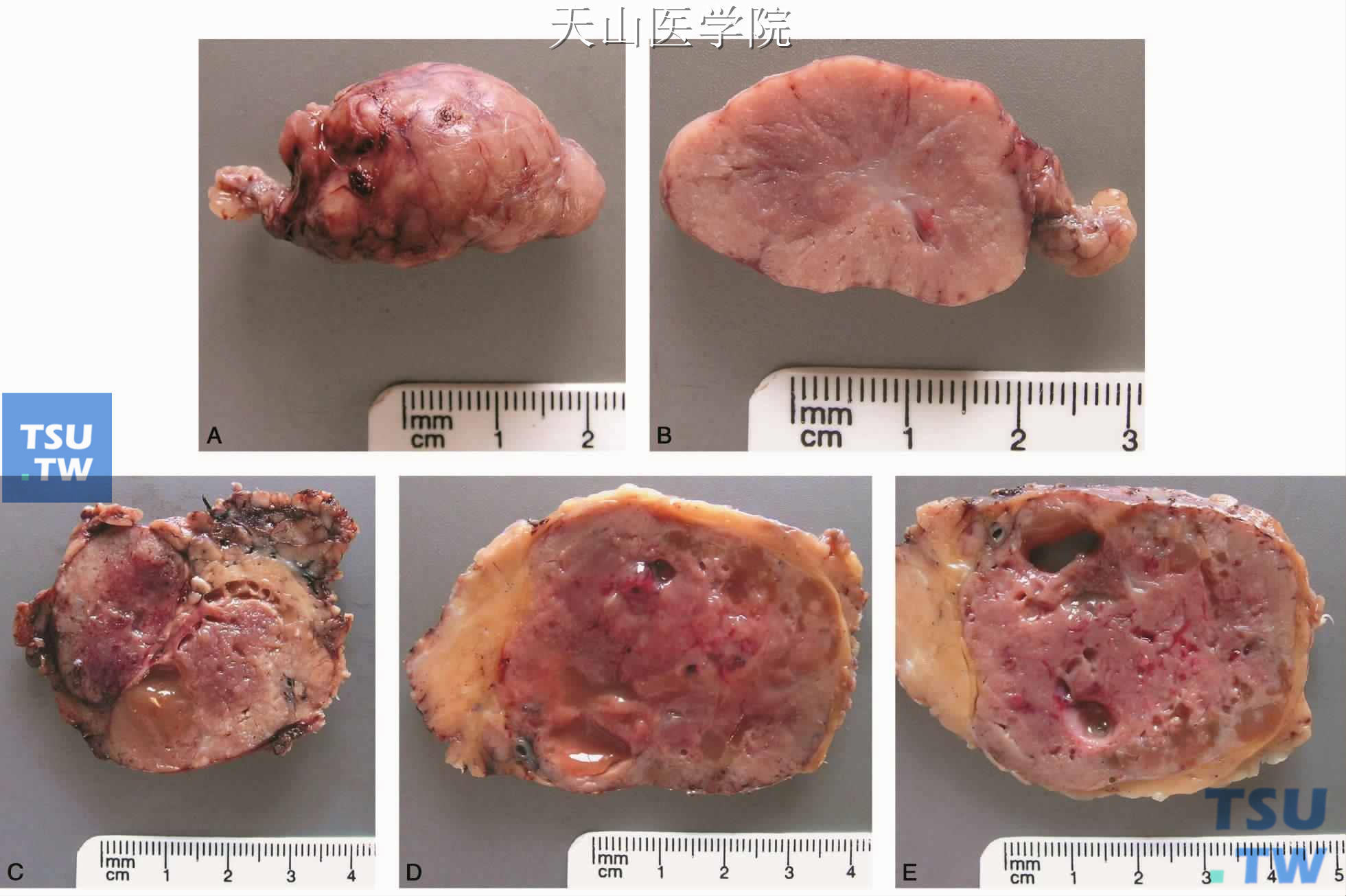 沃辛瘤的大体表现  A、B.为同一例；C.为1例；D、E.为同一例（罗海燕分切、摄影）