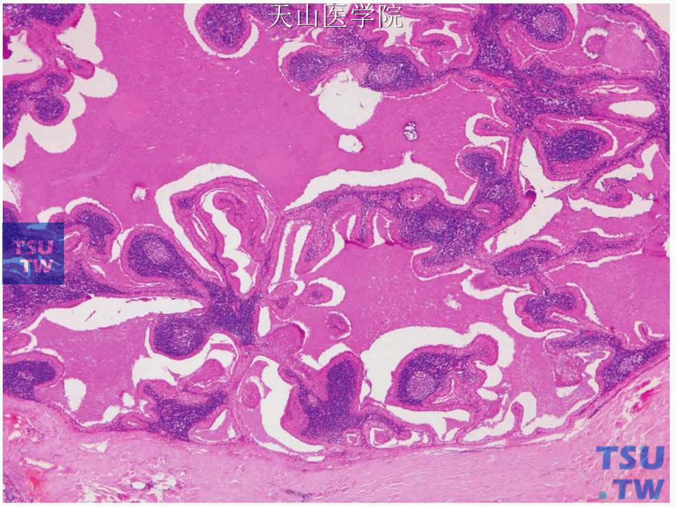 沃辛瘤:肿瘤形成囊腔，内见上皮衬覆的乳头状突起，上皮下为淋巴组织间质