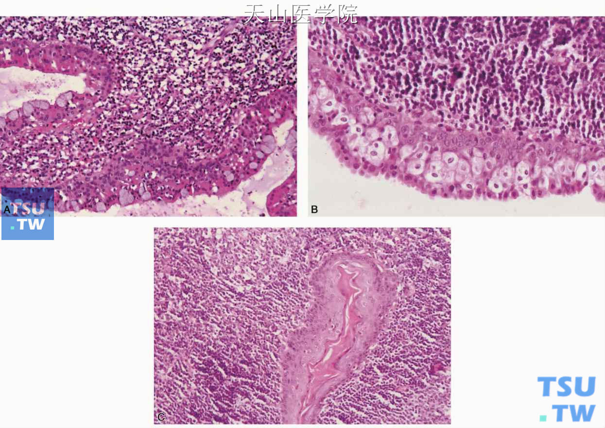 沃辛瘤  A.黏液细胞化生；B.皮脂细胞化生；C.鳞状化生