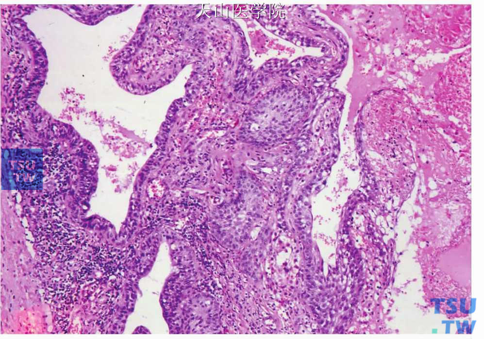 沃辛瘤：梗死型，梗死区位于图的右侧，中间区可见鳞状化生