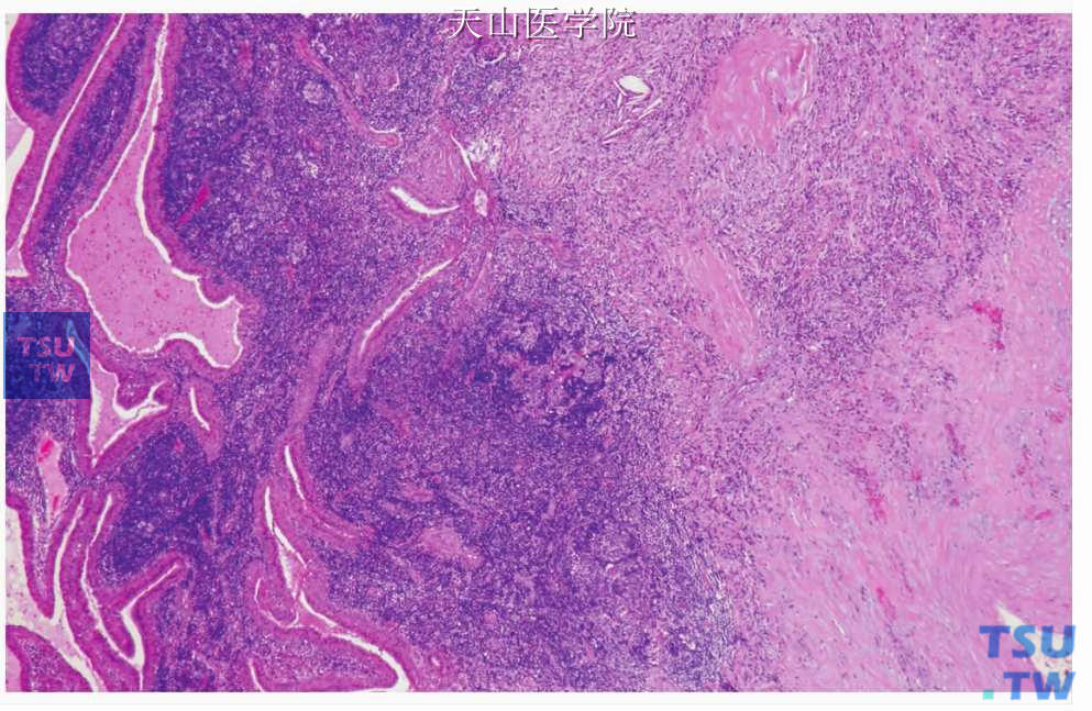 沃辛瘤：间质发生的纤维化、炎症细胞浸润及胆固醇结晶（中上部）