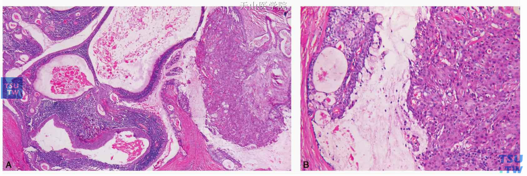 沃辛瘤 ：黏液表皮样癌变：A.低倍镜下见癌变区位于图的右侧；B.高倍镜下见典型的黏液表皮样癌结构