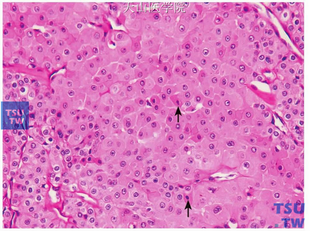嗜酸细胞瘤：大部分肿瘤细胞核为泡状（亮细胞），少许细胞的细胞核深染，胞质染色较深（暗细胞，箭头）