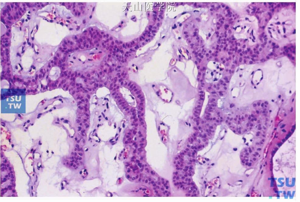管状腺瘤：肿瘤细胞排列成双排条索并且形成所谓的串珠样表现，局部见细胞核的长径与细胞索的方向垂直