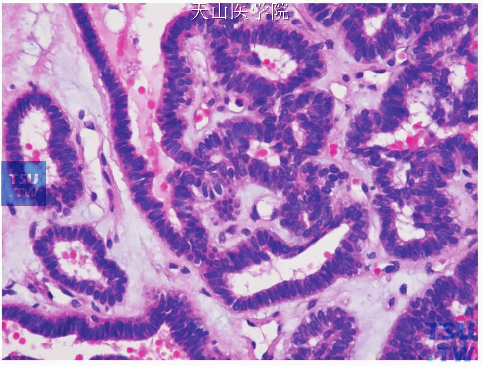 管状腺瘤：肿瘤细胞呈单排，柱状细胞核的长径与细胞索的方向垂直