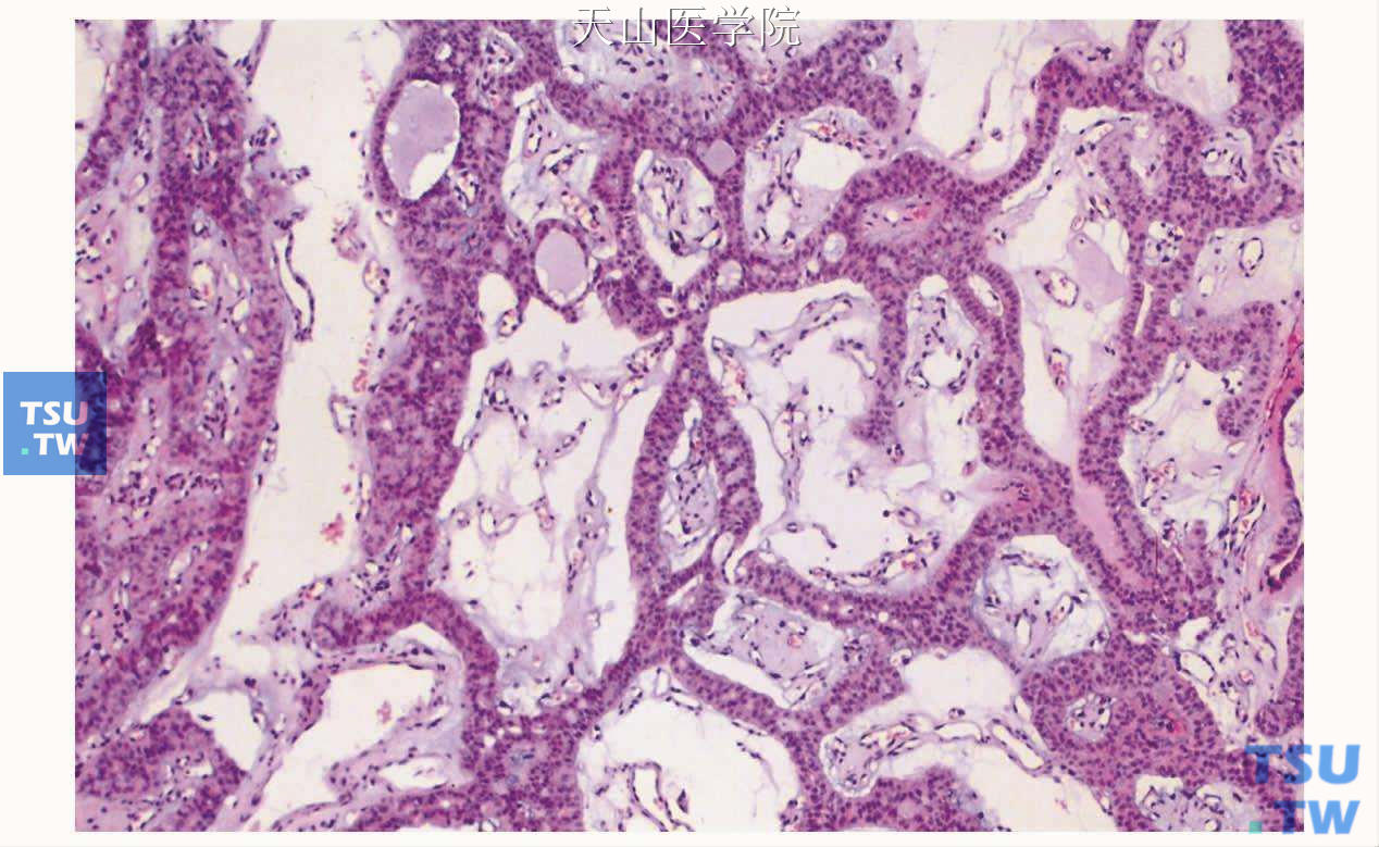 管状腺瘤：肿瘤的间质内水肿、含较多的毛细血管