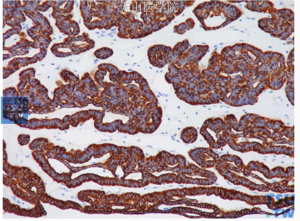 管状腺瘤：肿瘤细胞表达CK7，免疫组化染色