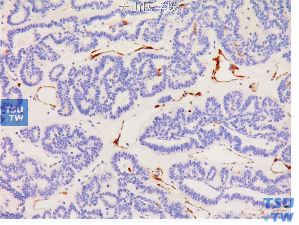 管状腺瘤：肿瘤细胞调宁蛋白阴性，间质血管阳性