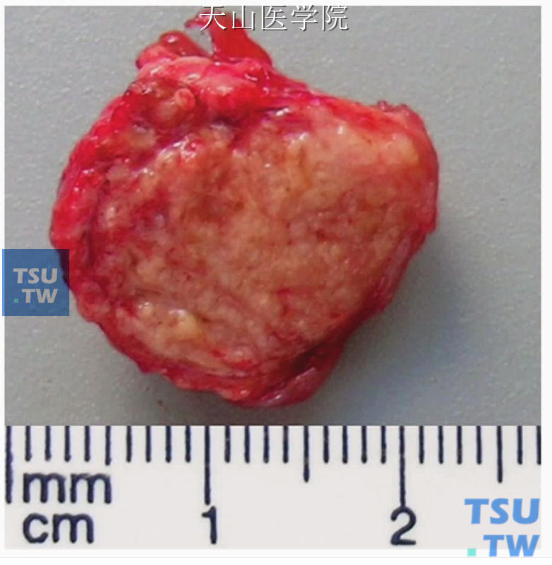 皮脂腺瘤：肿瘤界限清楚，切面浅黄色