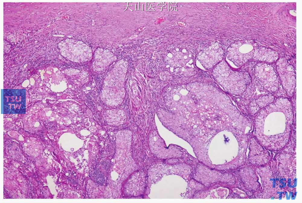 皮脂腺瘤：肿瘤分化成腺小叶样结构，局部见微囊
