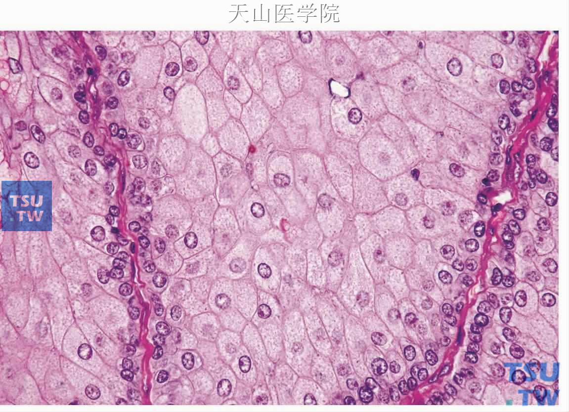 皮脂腺瘤：肿瘤细胞团中央细胞体积大，细胞界限清楚，胞质丰富，类似正常皮脂腺细胞，细胞团周边为小的基底样细胞