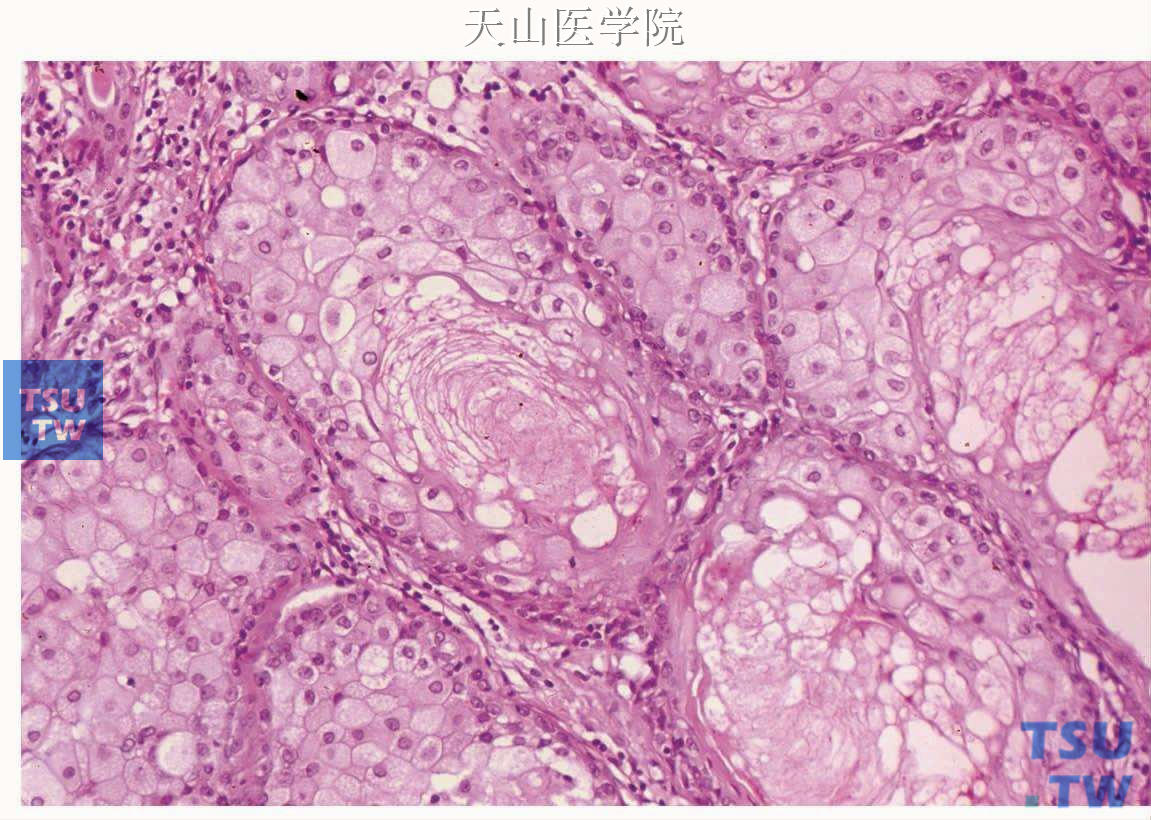 皮脂腺瘤：肿瘤细胞团中央为嗜酸性皮脂细胞分泌物