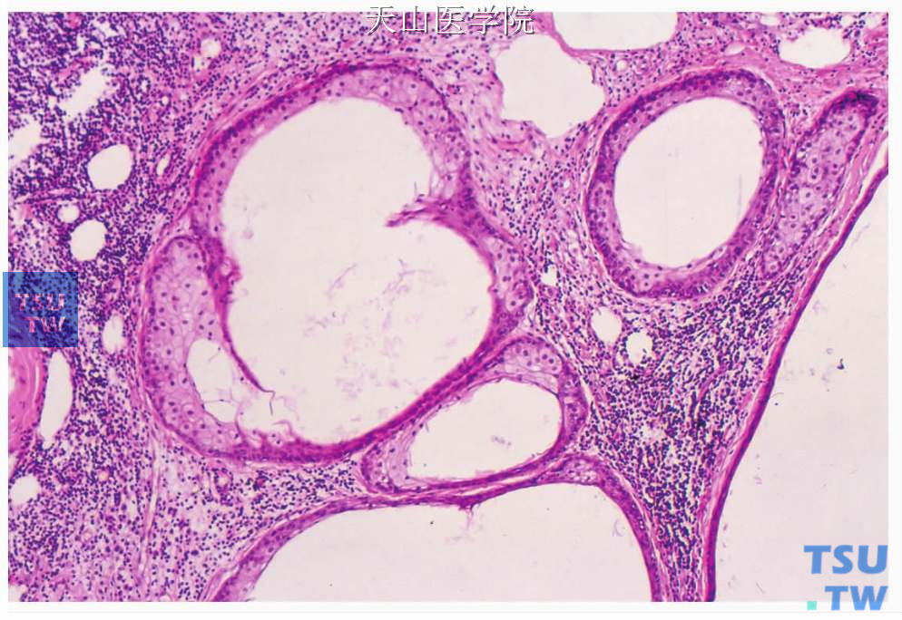 皮脂淋巴腺瘤：肿瘤上皮成份形成囊、管样结构，内衬皮脂样细胞，间质淋巴组织丰富
