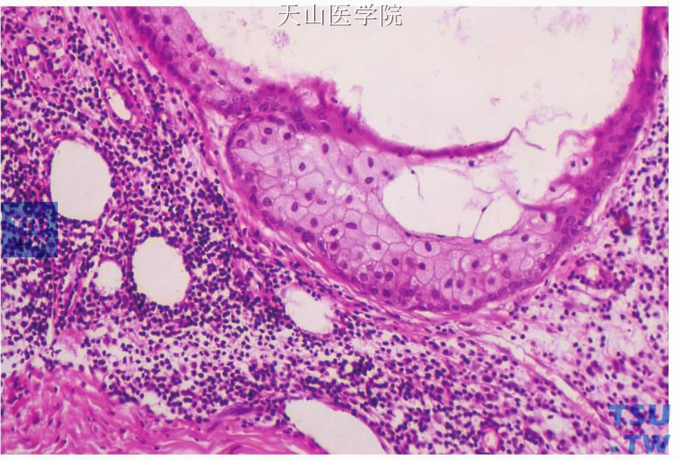 皮脂淋巴腺瘤：肿瘤的囊性结构中的皮脂样细胞，靠近淋巴组织的细胞为基底样