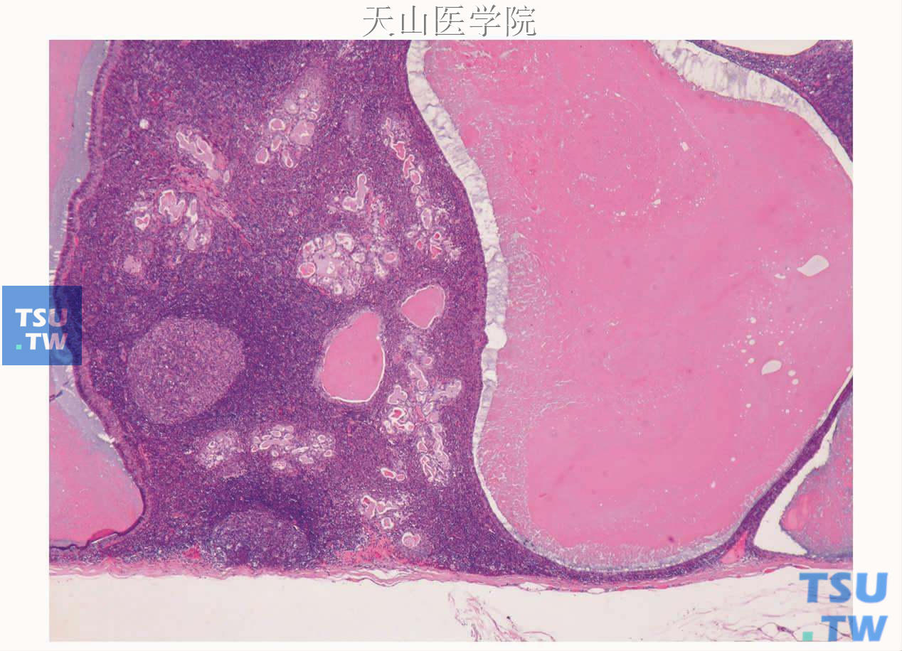 非皮质淋巴腺瘤：肿瘤上皮成份呈囊管状，间质含大量淋巴样组织，可见淋巴滤泡，肿瘤包膜下未见淋巴窦样结构