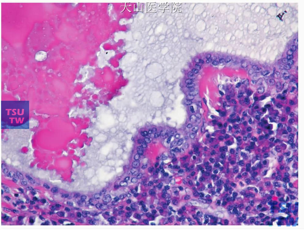 非皮质淋巴腺瘤：囊样结构的内衬上皮细胞为立方样