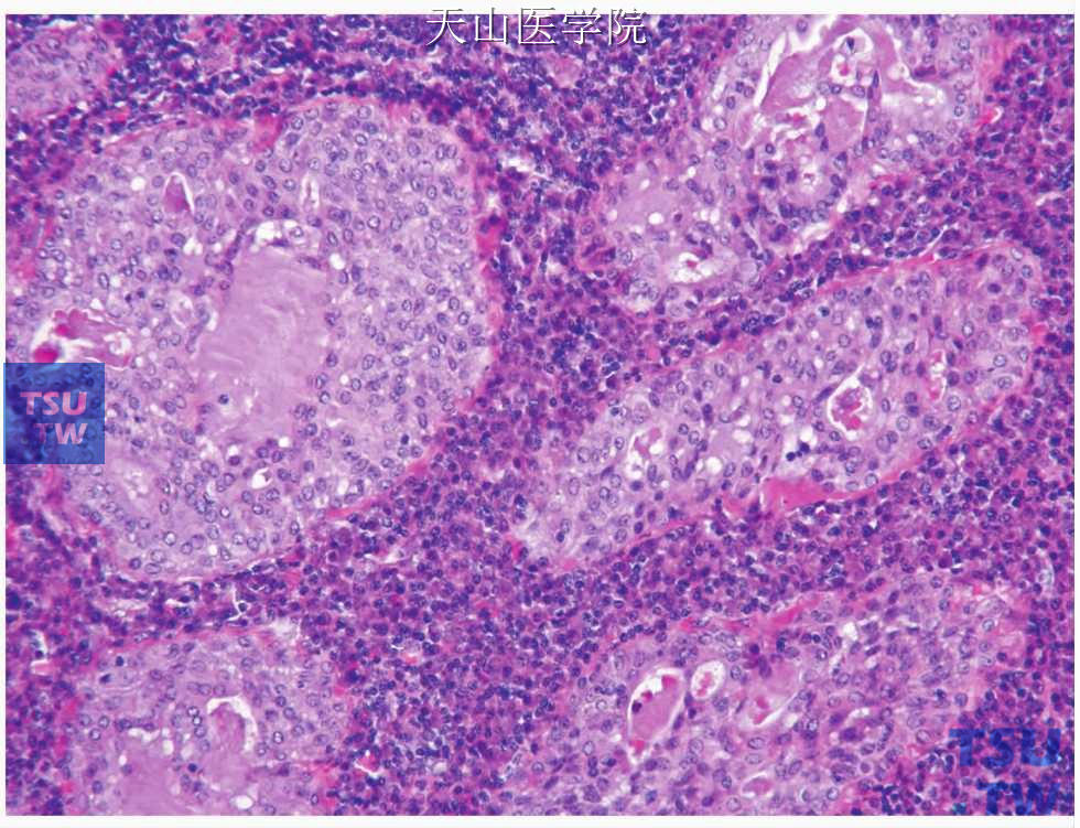 非皮质淋巴腺瘤：增生的上皮排列成实性导管或基底样岛