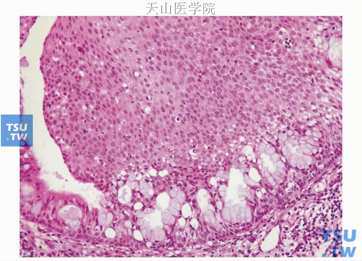 内翻性导管乳头状瘤：鳞状上皮呈乳头状增生突入管腔内，局部见黏液细胞