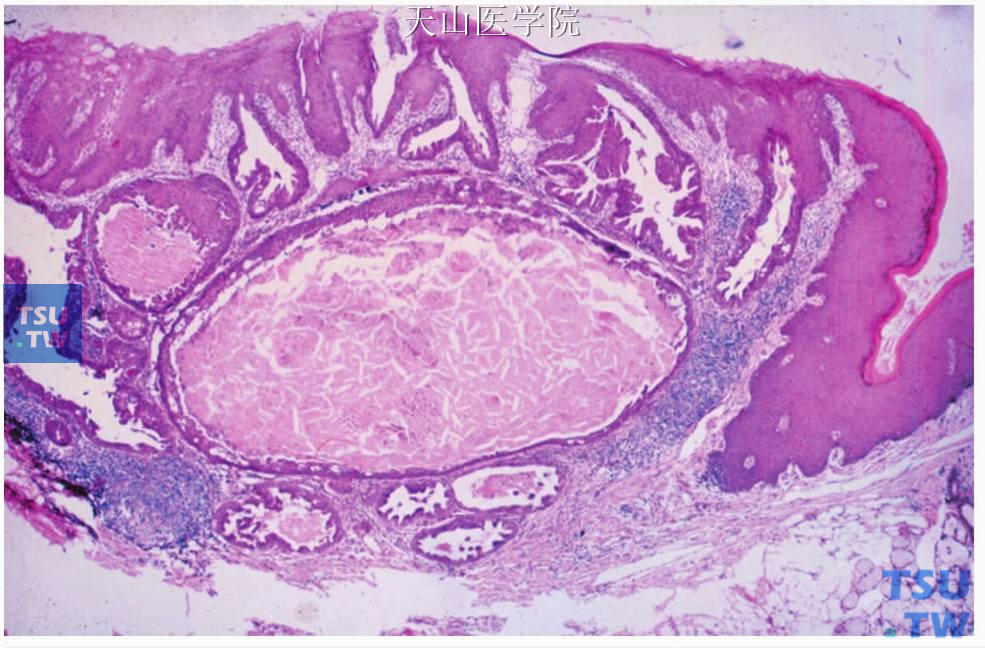 乳头状唾液腺瘤 ：黏膜表面形成突起性肿物，鳞状上皮轻度增生，深部见裂隙样导管结构，导管局部扩张