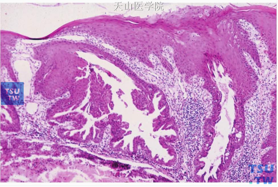 乳头状唾液腺瘤：导管中含有乳头，呈裂隙样
