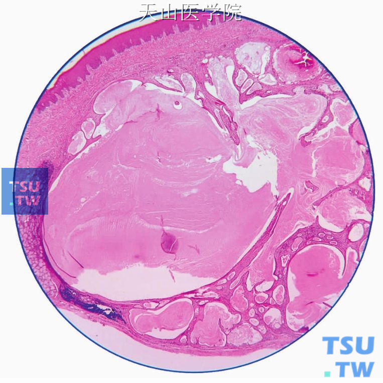 WHO对囊腺瘤（cystadenoma）的定义是主要以多囊性生长为特征的罕见的唾液腺上皮性肿瘤，囊的内衬上皮常呈乳头状，少见情况下为黏液性，上皮成分呈腺瘤样增生。因此将囊腺瘤分为乳头状囊腺瘤（papillary cystadenoma）和黏液性囊腺瘤（mucinous cystadenoma）两种类型。实际上早在1941年，Skorpil就报道了8例唾液腺的乳头状囊腺瘤。在WHO 1991年唾液腺肿瘤组织学分类以前，该肿瘤被归类于单形性腺瘤，也曾称为囊性导管腺瘤（cystic duct adenoma）、不含淋巴样间质的沃辛瘤（Warthin tumour without lymphoid stroma）、嗜酸细胞囊腺瘤（oncocytic cystadenoma），也有人认为该瘤为唾液腺导管的反应性囊性增生，而不是真性肿瘤，将其称为导管扩张（duct ectasia）、唾液腺导管囊肿（salivary duct cyst）和导管内乳头状增生（intraductal papillary hyperplasia），但目前认为是肿瘤性。  大多数学者认为囊腺瘤来源于唾液腺闰管的上皮。有人根据肿瘤细胞的角蛋白、上皮膜抗原及其黏蛋白的表达特点，认为可能来自于分泌管。  【临床表现】  据美国陆军病理研究所统计，囊腺瘤占唾液腺良性上皮性肿瘤的4. 1%。主要发生在大唾液腺，约占65%，多见于腮腺（45%～58%），其次是下颌下腺，舌下腺很少见。囊腺瘤占口内小唾液腺肿瘤的1. 2%～14%，以唇、颊部多见，其次是腭、舌、牙龈等。发病的年龄范围广，在12～91岁，平均57岁。女性多见，男女之比为1∶3～1∶2。  国内董绍忠等（1986）报告46例，占北京大学口腔病理室同期外检唾液腺上皮性肿瘤的2. 4%；男女各23例，年龄最小1. 5岁，最大72岁，平均就诊年龄36. 8岁；发病部位以腮腺最多，有19例（41. 3%），其次为腭，有9例（19. 6%），磨牙后腺5例（10. 9%）。上海的一项4743例唾液腺良性肿瘤中，囊腺瘤有28例，占0. 59%。  局部表现为生长缓慢的无痛性肿块，界线清楚，发生于腮腺者可移动。发生在小唾液腺者直径通常小于1cm。个别病例临床表现相似于黏液囊肿。发生于腭部的肿瘤有时表面出现创伤性溃疡。唾液腺造影大多为良性压迫性改变，部分病例有侵蚀现象和恶性征表现。  唾液腺型的囊腺瘤也发生在喉、泪腺、下颌骨、鼻咽部，气管支气管，相似的病例也见于附睾、卵巢和肾脏。  【大体病理】  肿物为圆形或结节状，大小不等，中等硬度，局部有囊性感。剖面为灰白色或淡黄色，可见大小不等的囊腔，有的囊腔内有白色胶冻样物，在大的囊腔内有小的乳头突起。肿瘤有包膜或包膜不完整。  【组织病理】  镜下见肿瘤一般为多囊性、界限清楚，可有包膜（图7-88）。偶见单囊性。囊性结构的数量和大小依不同病例而不同。囊的上皮衬里在不同肿瘤或在同一肿瘤内也会有不同，可薄可厚，为一列或数列细胞（图7-89、7-90）。常见囊腔内乳头状突起。衬覆囊腔的上皮可为立方细胞、柱状细胞、黏液细胞，少见情况下为扁平细胞，甚至是鳞状细胞，细胞核大小一致，温和（图7-91、7-92）。核分裂罕见，一般无细胞非典型性。立方细胞的胞质嗜酸性，胞核较大，圆形或椭圆形，位于细胞中央，核仁清晰；柱状细胞的胞质嗜酸性，核近腺腔面似Warthin瘤的柱状细胞（图7-93）；黏液细胞呈柱状、立方状或不规则的圆形，细胞较大，胞质着色浅，呈小空泡状，胞核较小，大多位于细胞的基部（图7-94、7-95）。常见囊腔内面和乳头表面大多被覆一层黏液细胞或柱状细胞，深面为数层立方细胞。这些内衬上皮细胞也可以是混合存在。有的较大囊腔内突入的乳头体积较大，上皮细胞可呈腺瘤样增生，形成筛状结构（图7-92）或“罗马桥”结构。内衬上皮以黏液细胞为主时可称为黏液性囊腺瘤（图7-95）。   图7-88　囊腺瘤  肿瘤界清，有部分包膜   图7-89　囊腺瘤  肿瘤囊腔主要内衬单层细胞  有的肿瘤只有单个囊腔，但当突入囊内的乳头含结缔组织轴时，应诊断为导管内乳头状瘤。也有人认为应将单囊性、含腔内乳头状突起的病变诊断为导管内乳头状瘤而不是囊腺瘤。   图7-90　囊腺瘤  高倍镜下见内衬立方细胞   图7-91　囊腺瘤  肿瘤囊腔内衬复层上皮细胞并形成乳头突入腔内   图7-92　囊腺瘤  肿瘤囊腔衬覆立方细胞和黏液细胞，局部呈筛状结构   图7-93　囊腺瘤  肿瘤细胞似Warthin瘤的柱状细胞   图7-94　囊腺瘤  肿瘤囊腔衬覆黏液细胞   图7-95　囊腺瘤  黏液细胞型  肿瘤中还可见灶性分布的大嗜酸细胞、顶浆分泌细胞，有时较广泛。有个别报道顶浆分泌细胞有轻度非典型性。嗜酸细胞囊腺瘤（oncocytic cystadenoma）由单层或双层嗜酸细胞性上皮呈乳头状囊性增生构成，类似于无淋巴样间质的Warthin瘤（图7-96）。嗜酸性上皮PTAH组化染色阳性。胞质呈线粒体抗原强阳性表达。据报道，一例嗜酸细胞囊腺瘤有明显的戒指环细胞（signet-ring cell）成分。   图7-96　囊腺瘤  嗜酸细胞型，肿瘤上皮细胞间散在黏液细胞  关于囊腺瘤的囊性结构以外有无实性肿瘤细胞区的意见不一致。有人认为偶见肿瘤的囊性结构之间有实性增生的上皮细胞区，排列成腺管样，团块状；也有人认为囊腺瘤通常无囊腔外的实性上皮团的成分。  肿瘤的囊腔内可含有嗜酸性蛋白物质，有时见一些上皮细胞和炎症细胞。偶见砂砾体、富含酪氨酸的晶状体和非酪氨酸α淀粉酶（alpha-amylase）晶状体。部分较大囊腔上皮衬里消失，形成纤维结缔组织环绕的黏液池。间充质数量不等，结缔组织可发生玻璃样变性。有时有密集的淋巴细胞，偶见淋巴滤泡形成。  【免疫组织化学】  肿瘤囊性结构的内衬上皮细胞种类多，免疫组织化学染色无固定模式。一般肿瘤细胞CK7阳性、EMA阳性，CK20阴性。也有研究显示MUC1、MUC4和MUC6阳性；MUC2、MUC5AC和MUC5B阴性。Ki67标记指数小于5%。抗线粒体抗体可有效识别囊腺瘤的嗜酸细胞分化。  【超微结构】  立方细胞中有各种细胞器，基底细胞较小，有细胞核旁的张力细丝；双层的嗜酸细胞见主要的细胞器为背靠背的线粒体。其他细胞器少。  【遗传学】  囊腺瘤的遗传学研究很少。对1例囊腺瘤的研究显示有克隆性染色体数量改变（染色体2和18增加）。  【鉴别诊断】  主要包括含乳头结构的唾液腺肿瘤如Warthin瘤、乳头状囊腺癌、低级别黏液表皮样癌、腺泡细胞癌的乳头状囊性型和低级别筛状囊腺癌。唾液腺导管囊肿、阻塞导致的导管扩张、唾液腺多囊病等也需与囊腺瘤鉴别。  1) Warthin瘤：有的乳头状囊腺瘤的上皮结构与Warthin瘤相似，但后者很少见黏液细胞，间充质为密集的淋巴组织，常见淋巴滤泡。  2)乳头状囊腺癌：肿瘤细胞有明显异型性，常出现核浓染，有双核、多核及核分裂像，肿瘤无包膜，呈浸润性生长。常有区域淋巴结转移。  3)多囊性乳头性黏液表皮样癌：可能与囊腺瘤相似，但囊腺瘤中无黏液表皮样癌中的由表皮样细胞、黏液细胞和中间细胞构成的实性巢。黏液表皮样癌中的乳头较囊腺瘤的乳头更不规则和复杂。  4)腺泡细胞癌的乳头状囊性型：可能与囊腺瘤鉴别困难。仔细寻找典型的腺泡细胞癌的区域或者抗淀粉酶消化的PAS阳性胞质颗粒可以确定诊断。此外，腺泡细胞癌很少有纯的乳头状囊性，通常有一些一致的立方状闰管样细胞以及更复杂的如筛状或微囊结构的细胞增生区。  5)低级别筛状囊腺癌：与囊腺瘤不同，有腔内的筛状、微乳头和实性区。而且，囊腺瘤的乳头含有结缔组织轴，这在低级别筛状囊腺癌不存在。  6)导管扩张和单纯囊肿的内衬上皮平滑，腔内无乳头状突起。此外，导管扩张常常累及数个节段的导管，并且与邻近腺体的纤维化、腺体萎缩和慢性炎症相关。多囊病特别罕见，弥漫累及整个腺体，而囊腺瘤界限清楚。  7)导管内乳头状瘤：组织学表现与囊腺瘤有重叠，导管内乳头状瘤是与囊腺瘤不同的疾病还是囊腺瘤的一个亚型还未明了。有人提议将多囊的诊断为囊腺瘤，将单囊性者诊断为导管内乳头状瘤。如果病变累及多个导管，则诊断为囊腺瘤。  【治疗和预后】  治疗应彻底切除。以前曾认为囊腺瘤是潜在恶性的肿瘤，但目前认为是良性肿瘤。复发一般可能是由于肿瘤的多囊性结构、包膜常不完整或包膜内有瘤细胞生长所致。未见有破坏性生长及转移的病例。董绍忠等发现4例原发腮腺囊腺瘤的标本中存在孤立的小瘤灶，表明有多发中心存在。目前有1例黏液性囊腺瘤恶变为侵袭性微乳头腺癌的报道。