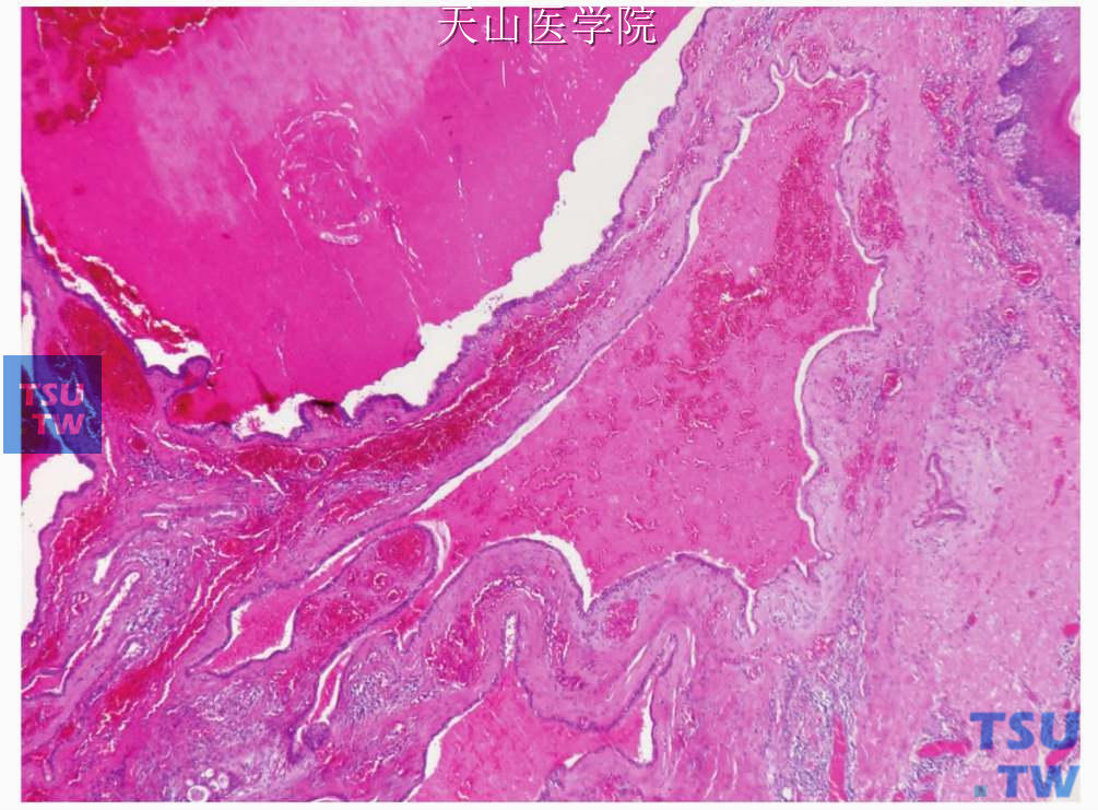 囊腺瘤：肿瘤囊腔主要内衬单层细胞