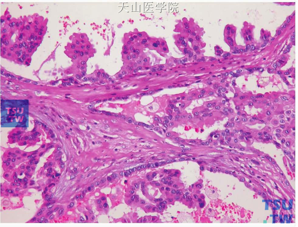 囊腺瘤：肿瘤囊腔内衬复层上皮细胞并形成乳头突入腔内