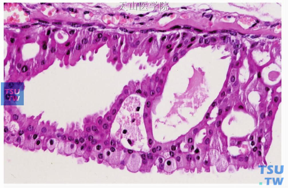 囊腺瘤：肿瘤囊腔衬覆立方细胞和黏液细胞，局部呈筛状结构
