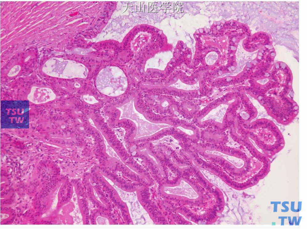 囊腺瘤：肿瘤细胞似Warthin瘤的柱状细胞