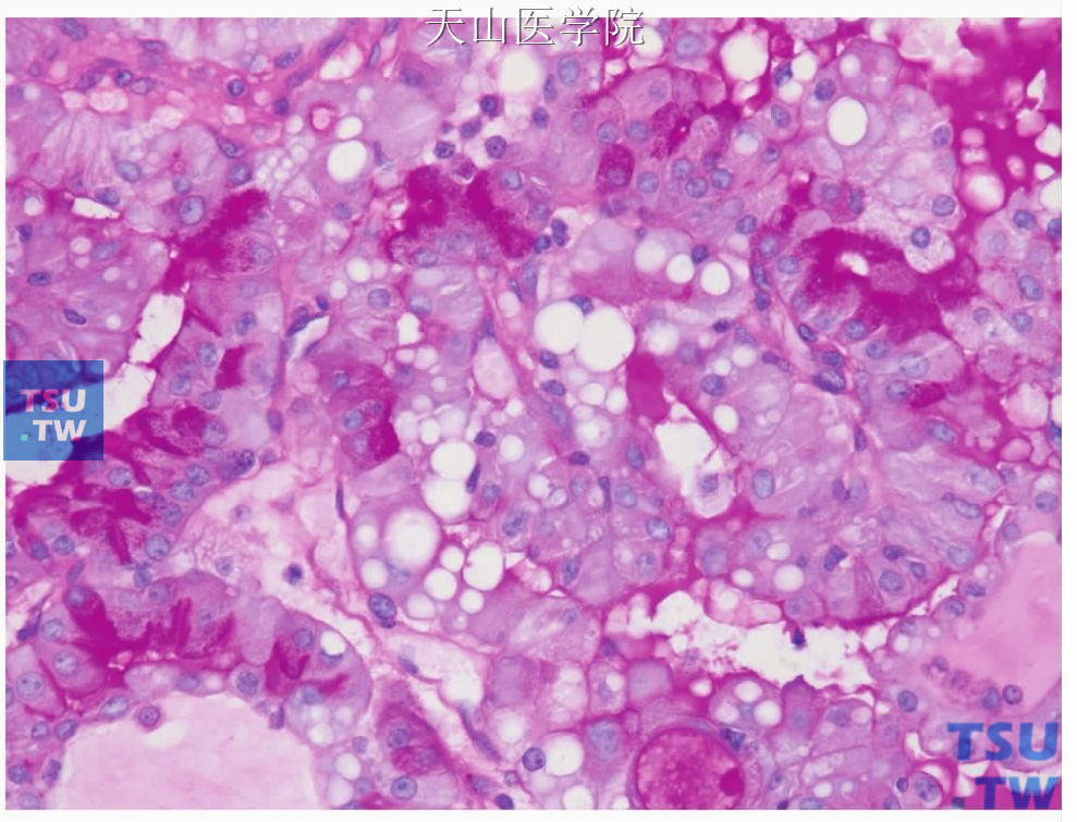 腺泡细胞癌：腺泡样细胞，PAS加淀粉酶消化后阳性