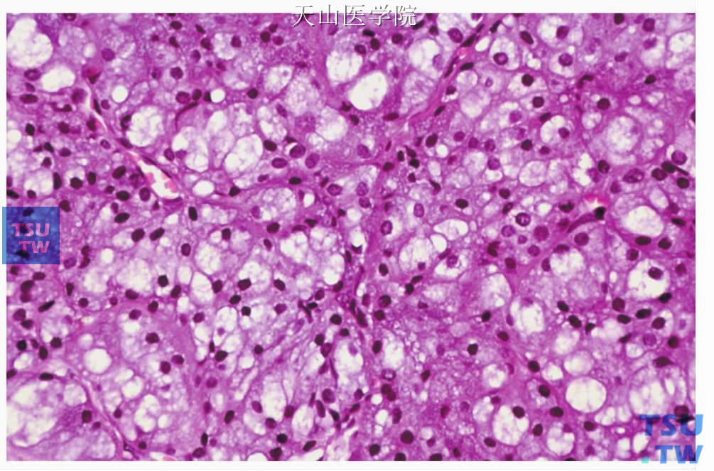 腺泡细胞癌：空泡状细胞，胞质内含大小不等的空泡