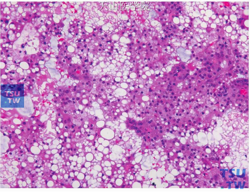 微囊型腺泡细胞癌：细胞间形成大量的微小囊状间隙，肿瘤细胞空泡变