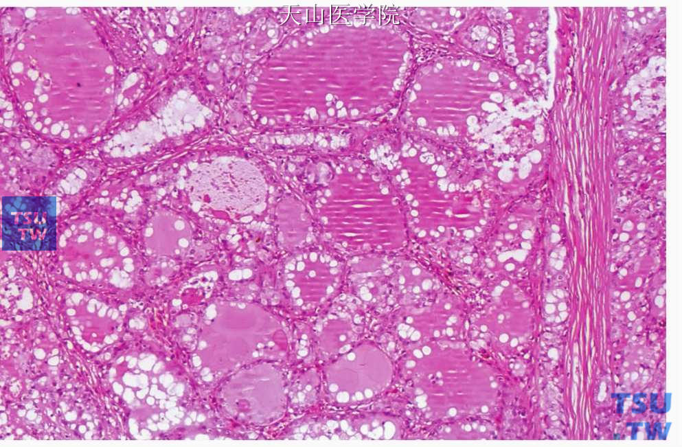 滤泡型腺泡细胞癌：肿瘤细胞排列成甲状腺滤泡样