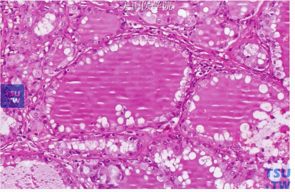 滤泡型腺泡细胞癌：构成滤泡的细胞为闰管样细胞