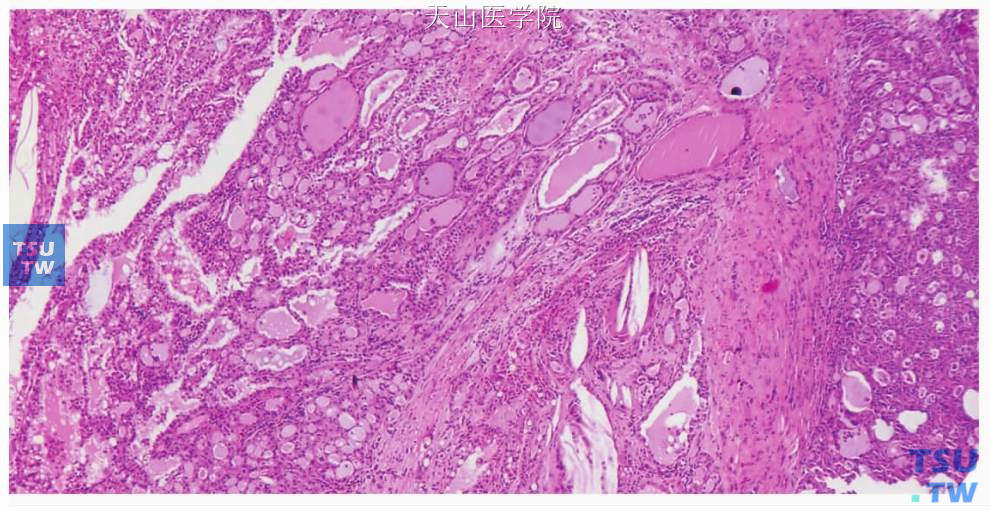 腺泡细胞癌高级别转化：肿瘤含腺泡细胞癌成份（左侧大部分）和高级别转化成份（右侧进边缘）
