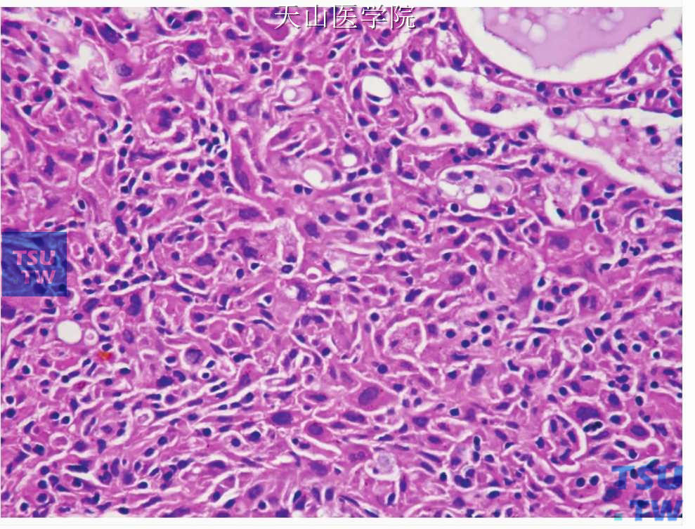 腺泡细胞癌高级别转化：转化部分为未分化癌
