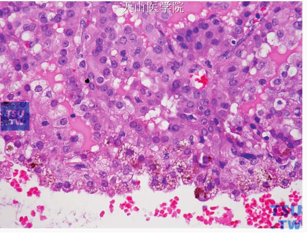 腺泡细胞癌：肿瘤细胞内间含铁血黄素