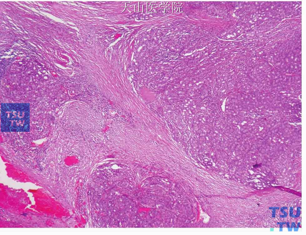 腺泡细胞癌：肿瘤无包膜，呈浸润性生长