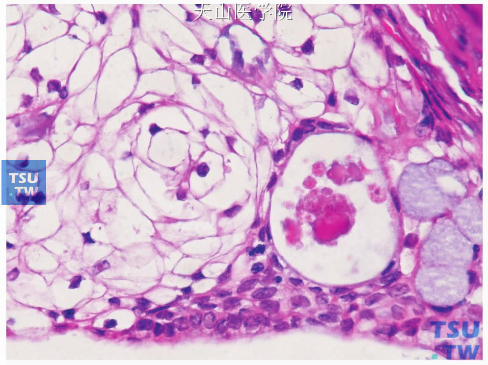 黏液表皮样癌：透明细胞（左侧）和黏液细胞右下角
