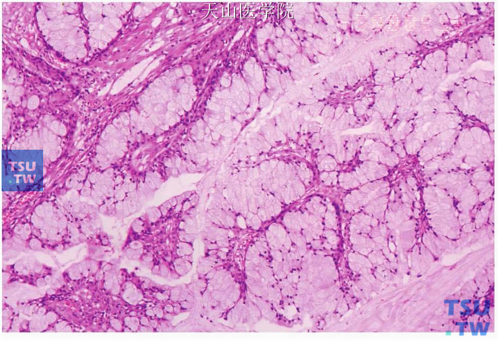 高分化黏液表皮样癌：肿瘤以黏液样细胞为主