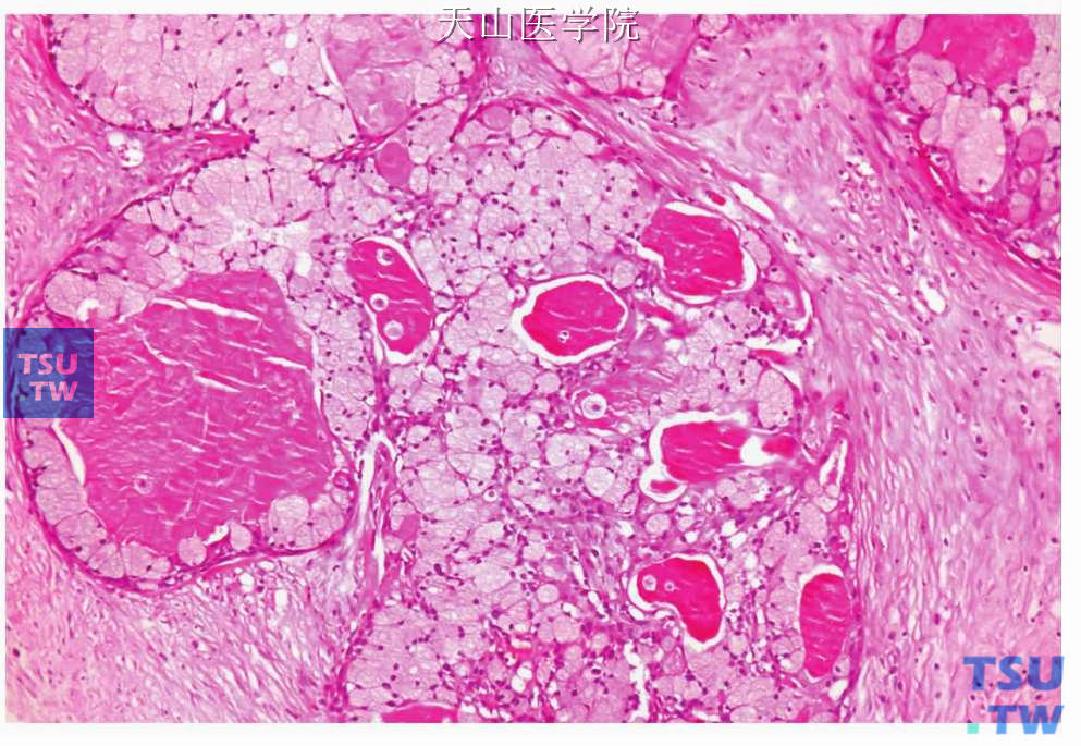高分化黏液表皮样癌：肿瘤形成的囊内含嗜酸性黏液