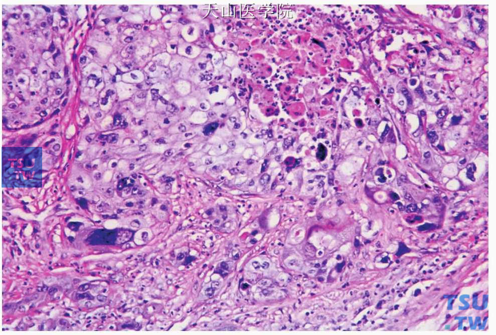 低分化黏液表皮样癌：肿瘤细胞的异型性明显，并见坏死