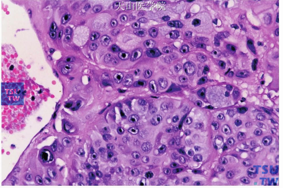 低分化黏液表皮样癌：部分肿瘤细胞核深染、核仁明显，围绕血管生长